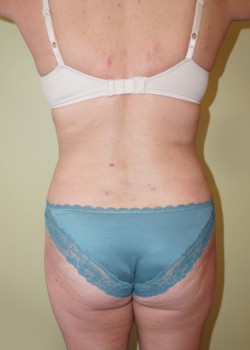 After Image: Liposuction Abdomen, Love Handles, and Back - back