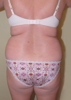 Before Image: Liposuction Abdomen, Love Handles, and Back - back