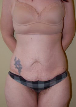 Before Image: Tummy Tuck - front