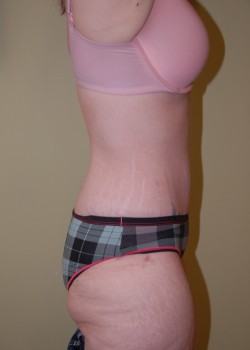 After Image: Tummy Tuck - other