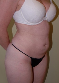 Before Image: Tummy Tuck, Liposuction - right-front-oblique