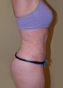 After Image: Tummy Tuck, Liposuction - other