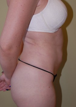 Before Image: Tummy Tuck, Liposuction - other
