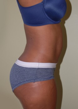 After Image: Liposuction Abdomen and Back - other