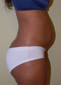 Before Image: Liposuction Abdomen and Back - other