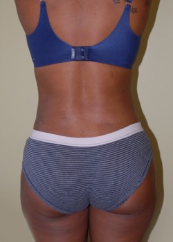 After Image: Liposuction Abdomen and Back - back