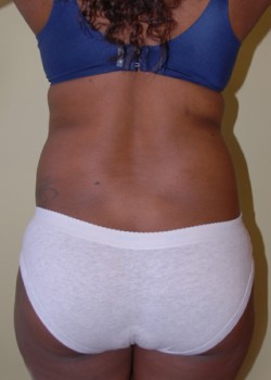 Before Image: Liposuction Abdomen and Back - back