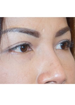 After Image: Asian Double Eyelid - right-front-oblique