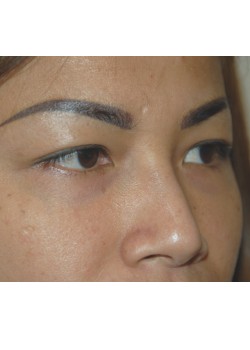 Before Image: Asian Double Eyelid - right-front-oblique