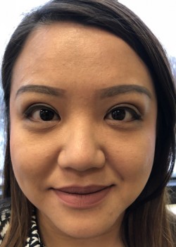 After Image: Asian Double Eyelid - front
