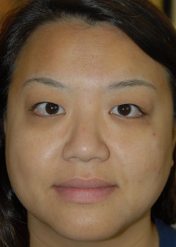 Before Image: Asian Double Eyelid - front