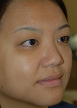 Before Image: Asian Double Eyelid - right-front-oblique