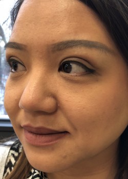 After Image: Asian Double Eyelid - left-front-oblique