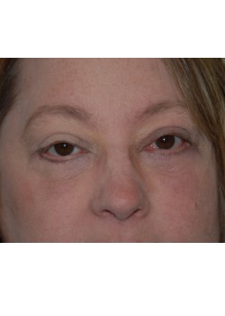 After Image: Upper and Lower Eyelid Surgery - front