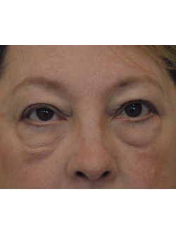 Before Image: Upper and Lower Eyelid Surgery - front