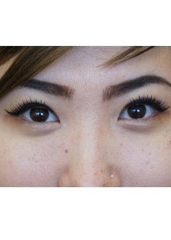 After Image: Asian Double Eyelid - front