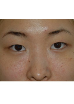 Before Image: Asian Double Eyelid - front