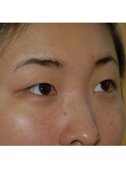Before Image: Asian Double Eyelid - right-front-oblique