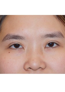 After Image: Asian Double Eyelid - front