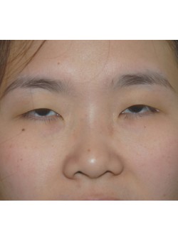 Before Image: Asian Double Eyelid - front