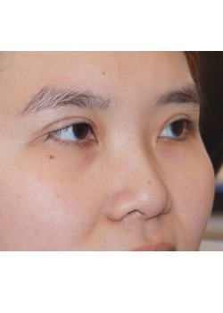 After Image: Asian Double Eyelid - right-front-oblique