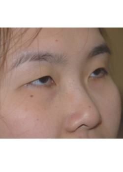 Before Image: Asian Double Eyelid - right-front-oblique
