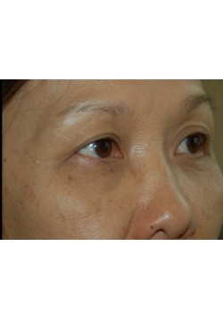 Before Image: Asian Double Eyelid - right-front-oblique