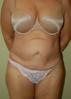 Before Image: Tummy Tuck, Liposuction - front