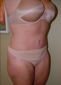 After Image: Tummy Tuck, Liposuction - right-front-oblique