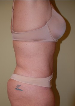 After Image: Tummy Tuck, Liposuction - other