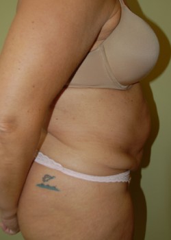 Before Image: Tummy Tuck, Liposuction - other