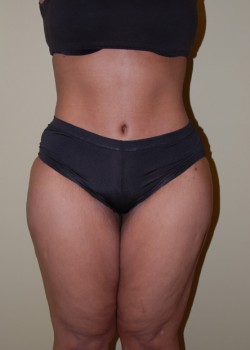 After Image: Tummy Tuck, Liposuction - front