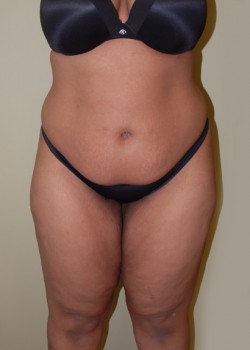 Before Image: Tummy Tuck, Liposuction - front