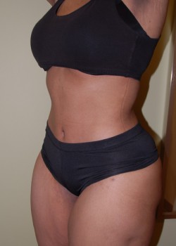 After Image: Tummy Tuck, Liposuction - left-front-oblique