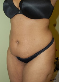 Before Image: Tummy Tuck, Liposuction - left-front-oblique