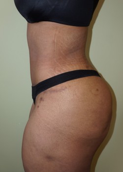 After Image: Tummy Tuck, Liposuction - other