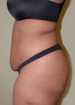 Before Image: Tummy Tuck, Liposuction - other