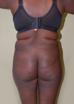 Before Image: Brazilian Butt Lift - back