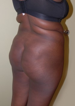Before Image: Brazilian Butt Lift - right-front-oblique