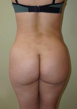After Image: Brazilian Butt Lift - front