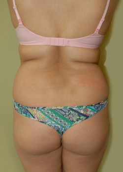 Before Image: Liposuction Abdomen and Back - front