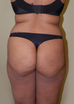 Before Image: Brazilian Butt Lift - back