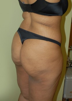 Before Image: Brazilian Butt Lift - right-front-oblique