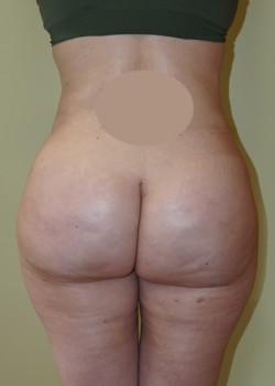 After Image: Brazilian Butt Lift - back