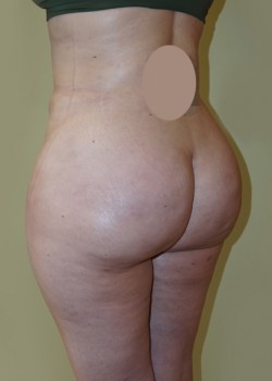 After Image: Brazilian Butt Lift - left-front-oblique