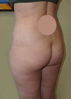 Before Image: Brazilian Butt Lift - left-front-oblique