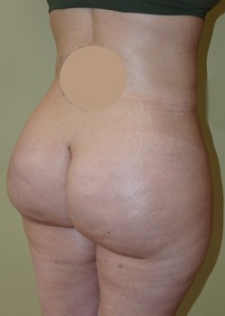 After Image: Brazilian Butt Lift - right-front-oblique