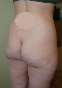 Before Image: Brazilian Butt Lift - right-front-oblique