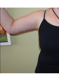 After Image: Arm Lift - front