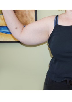 Before Image: Arm Lift - front